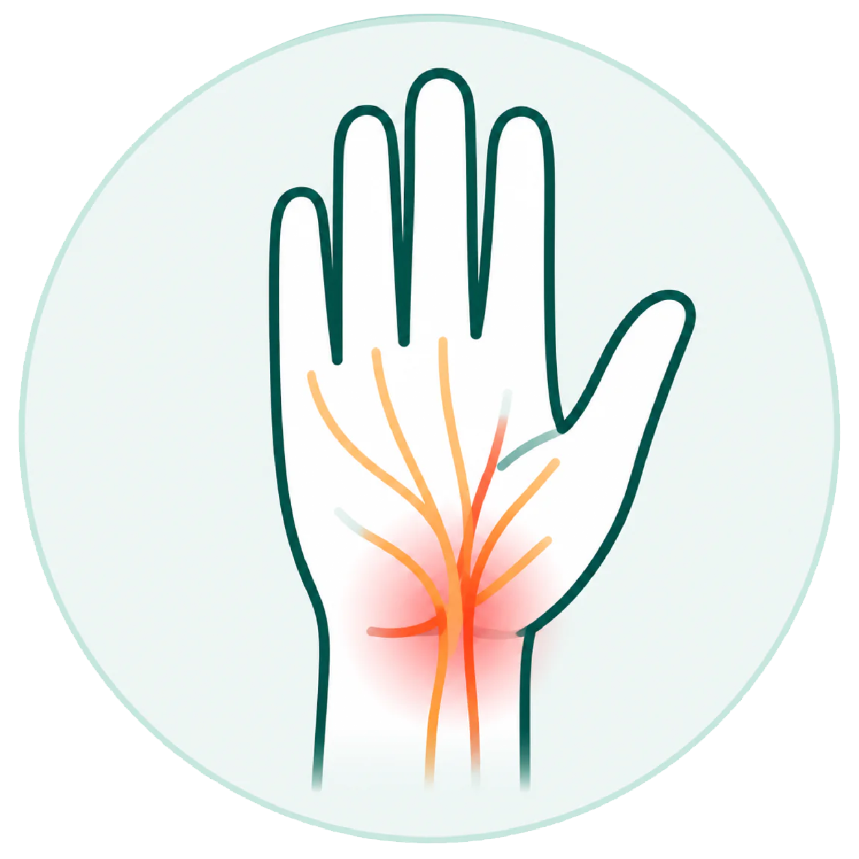 Illustration showing the carpal tunnel area of the hand and wrist